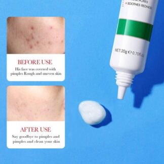 Acne Removal Cream 20g Hydrating Smooth Finish