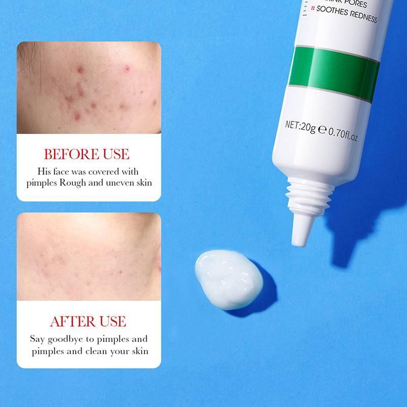 Acne Removal Cream 20g Hydrating Smooth Finish